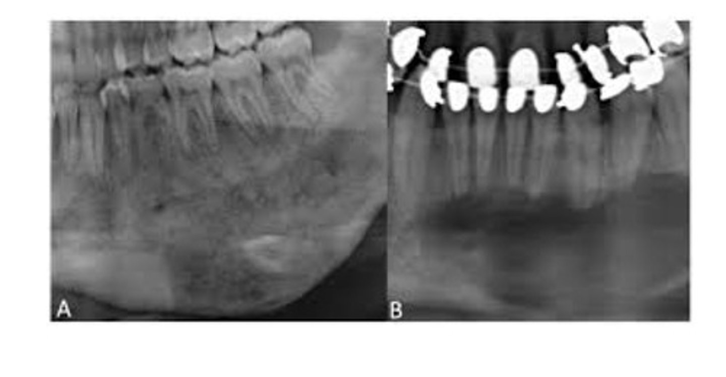 <p>Typically a painless, progressive, unilateral enlargement of the mandible or maxilla. The classic Radiographic appearance is a diffuse radiopacity looking like "ground glass". Characterized by cellular fibrous CT interspersed with irregularly shaped bony trabeculae.</p>