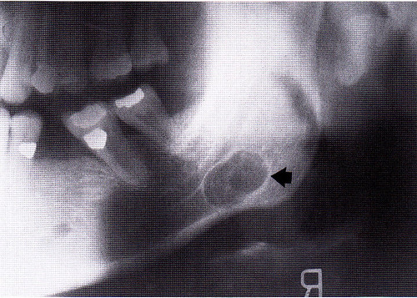 <p>radiolucent intraosseous lesion that is NOT lined with epitheium = NOT A TRUE CYST! **KNOW for exam</p><p>• also called Static Bone Cyst and Stafne Defect</p>