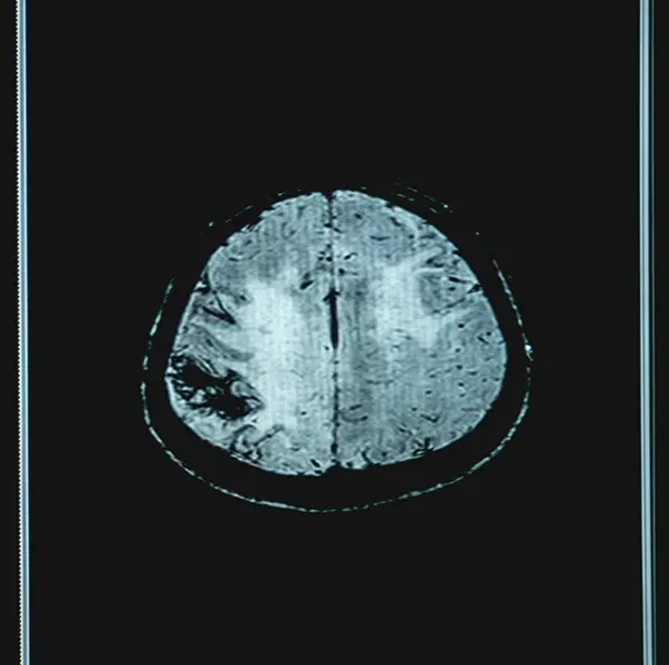 <p>Vascular dementia </p>