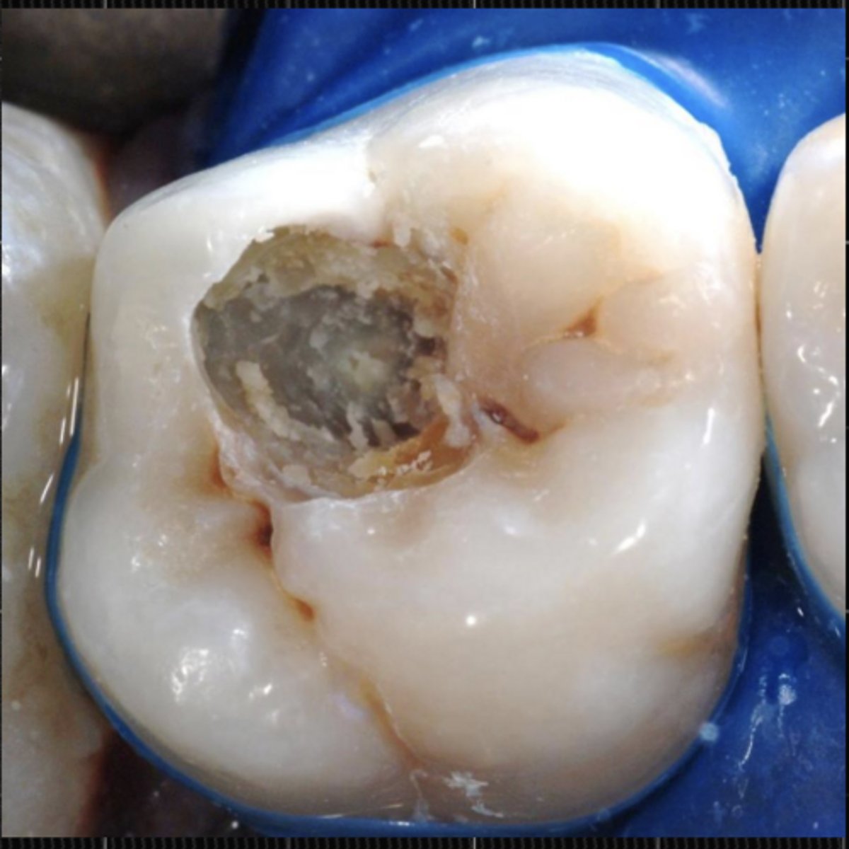 <p>Diagnosis of vital pulp - felt the cold</p><p>Pulpitis is Reversible</p><p>No clinical or radiographic pulp exposure</p><p>Periapical radiolucency (lesion) in x-ray</p><p>(Need all four to go forward with a restoration)</p>