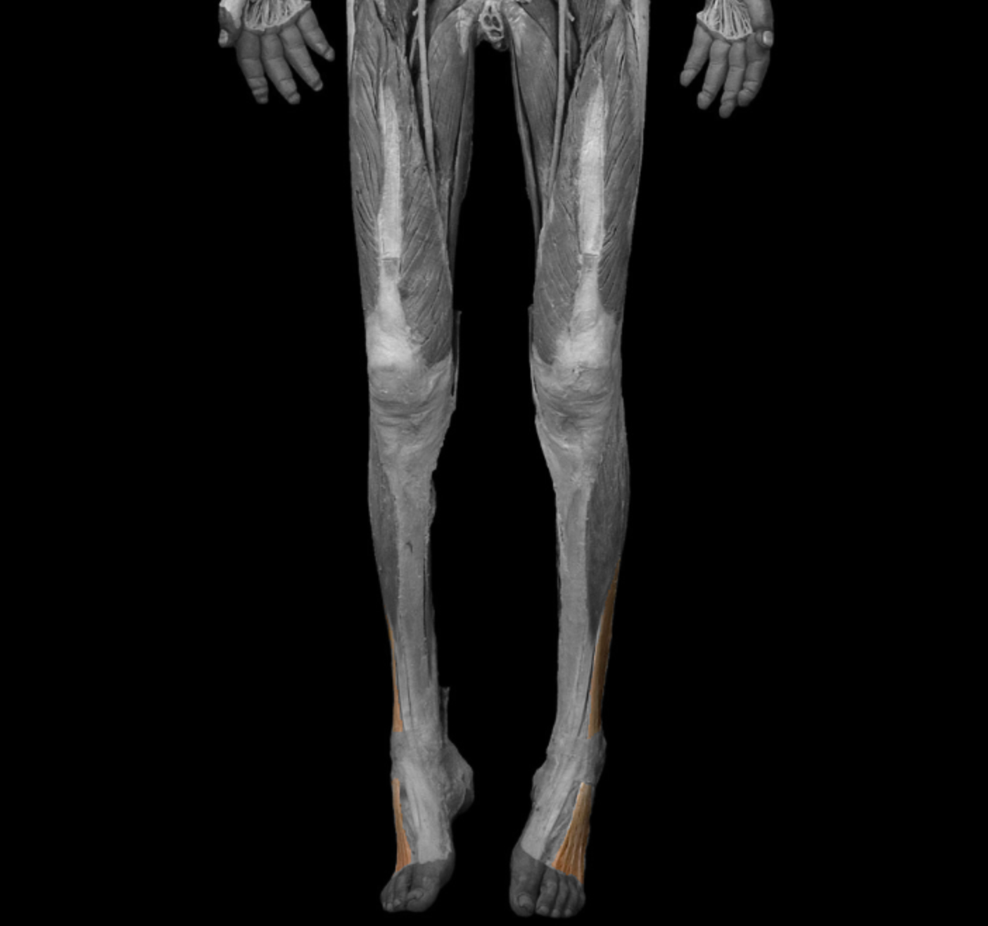 <p>origin: lateral condyle of tibia, anterior surface of fibula, interosseous membrane </p><p></p><p>insertion: middle and distal phalanges of toes II-IV </p><p></p><p>action: dorsiflex foot at ankle, extend distal/middle phalanges </p><p></p><p>innervation: deep fibular (peroneal) nerve </p>