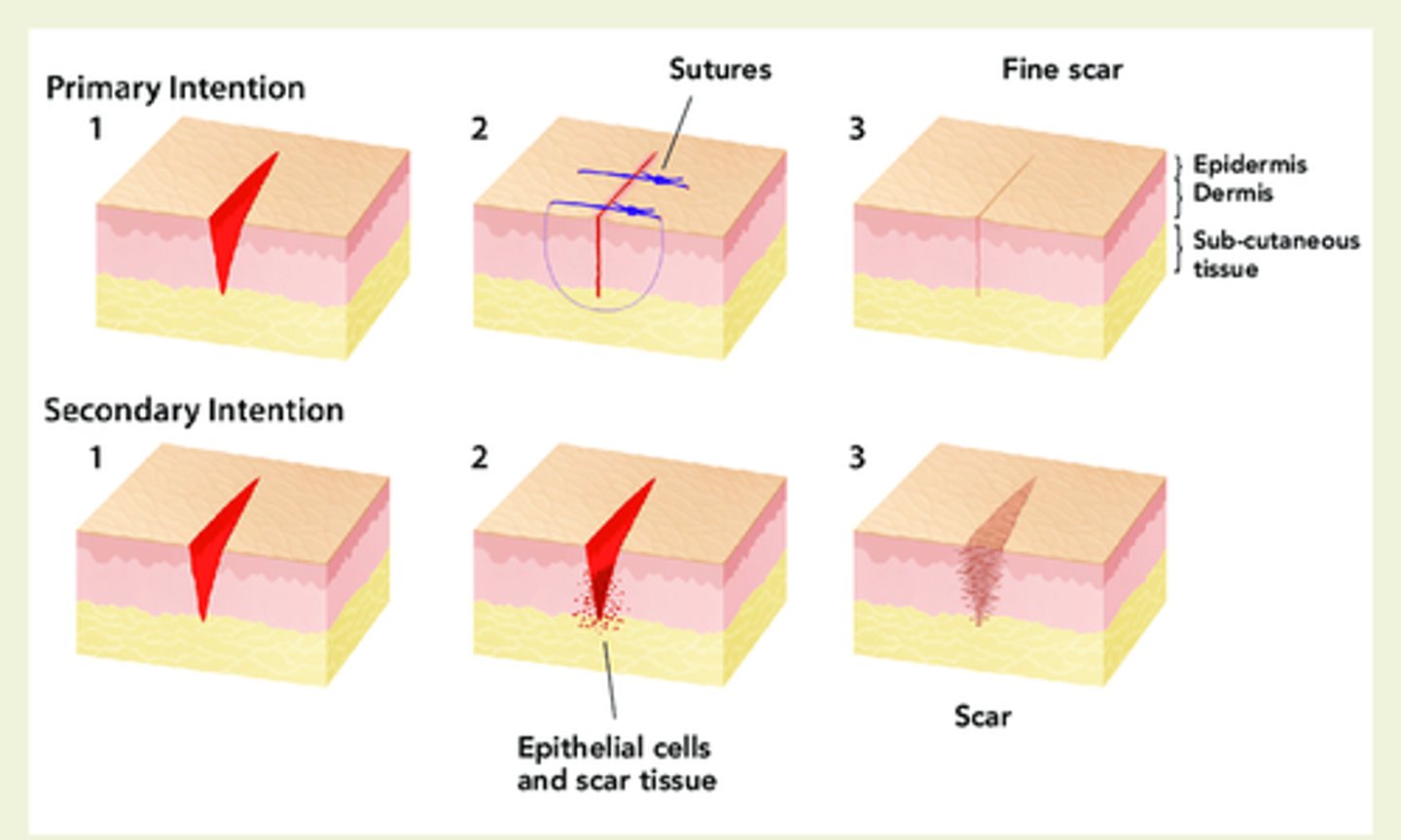 <p>Which type of healing?</p><p>1. Takes place when wound margins are closely adapted (Sutured closed) &amp; the wound heals from the TOP- Down</p><p>2. Minimum of exudate and debris </p><p>3. More rapid healing process </p><p>4. Usually planned procedures </p><p>5. Example --> closing an incision</p>