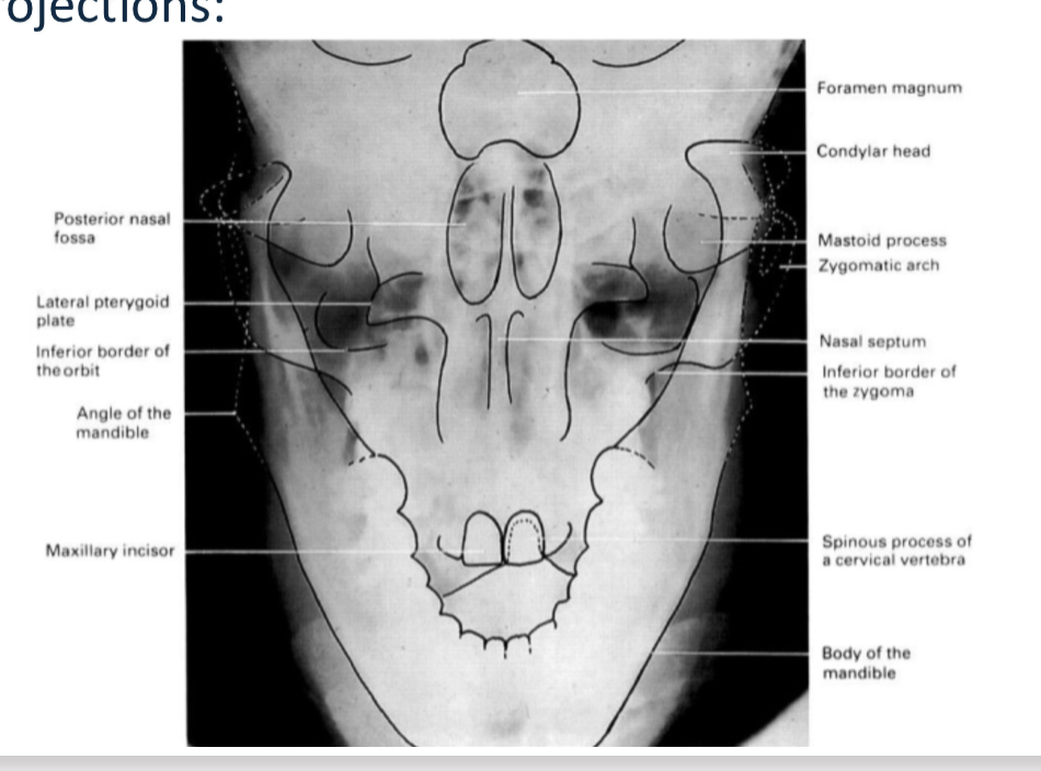 <p>Patient facing the sensor. Mid-Sagittal plane is aligned perpendicular to the midline of the sensor. Patient’s chin is tucked down to bring the head down 30º. Patient must open mouth as much as possible to visualize the condyles.</p>