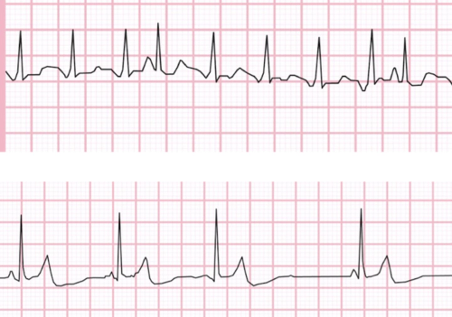 <p>-P waves present (varying morphology) </p><p>-need &gt; 3 different P wave morphology to diagnose </p><p>-narrow QRS </p><p>-1:1 P:QRS</p><p>-varying irregular PR intervals </p><p>-rate: 100-200bpm </p><p>-&lt;100bpm- wandering pacemaker </p><p>-origin: multiple sites in atria </p><p>-common in pts with severe lung disease </p>