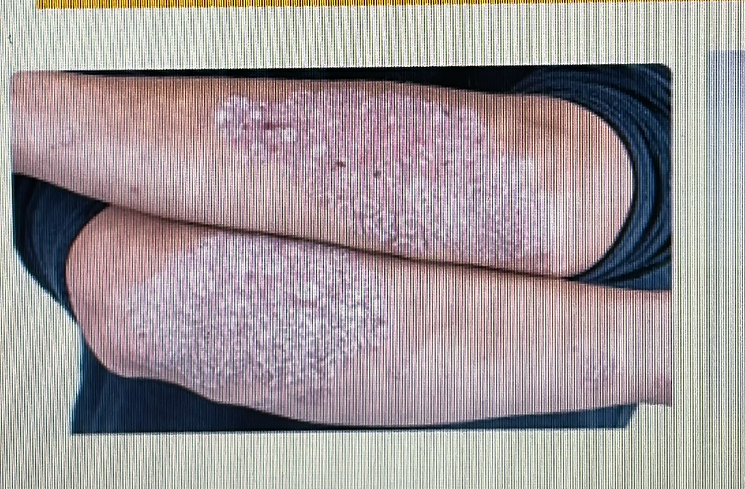 <p>SKIN DISORDER</p><p>psoriasis</p>