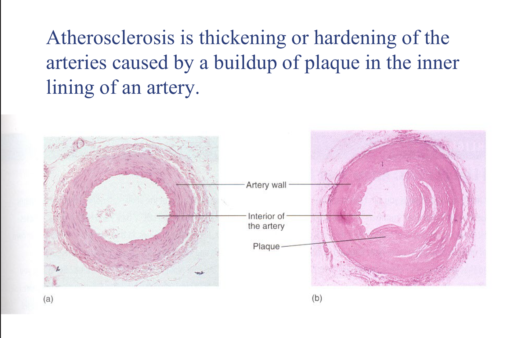 <p>when ‘bad cholesterol’ accumulate sin artery walls, leads to build up of plaque&nbsp;</p><ol><li><p>the fatty streak</p></li><li><p>fibrous plaque</p></li><li><p>complete lesion and calcification</p></li></ol><p></p>