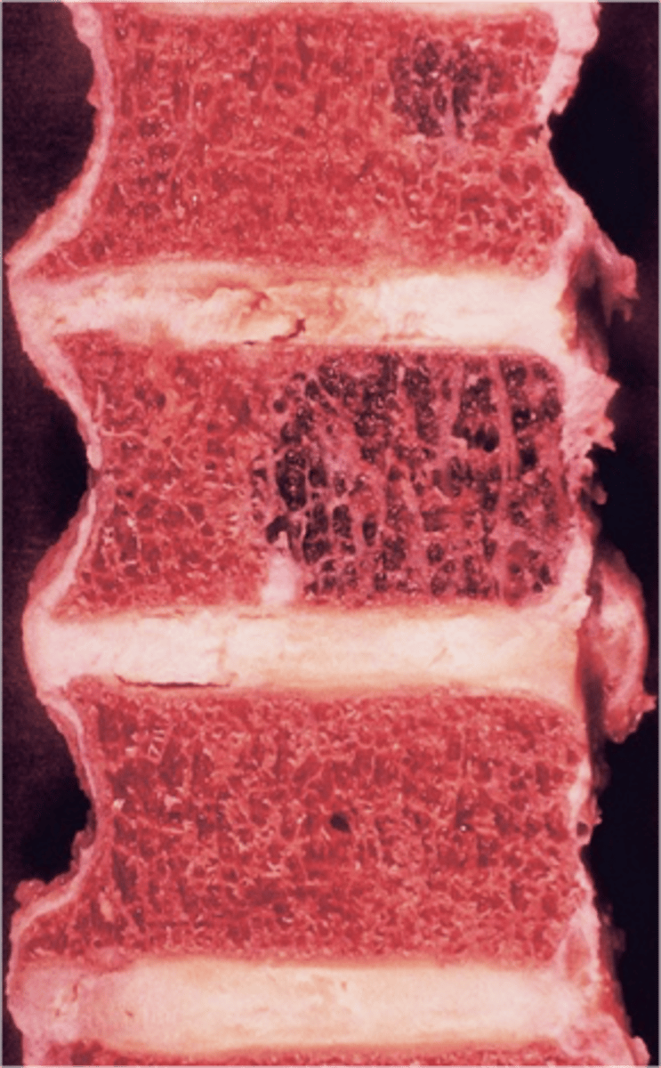 <p>- Solitary vascular neoplasm</p><p>- Slow growing</p>
