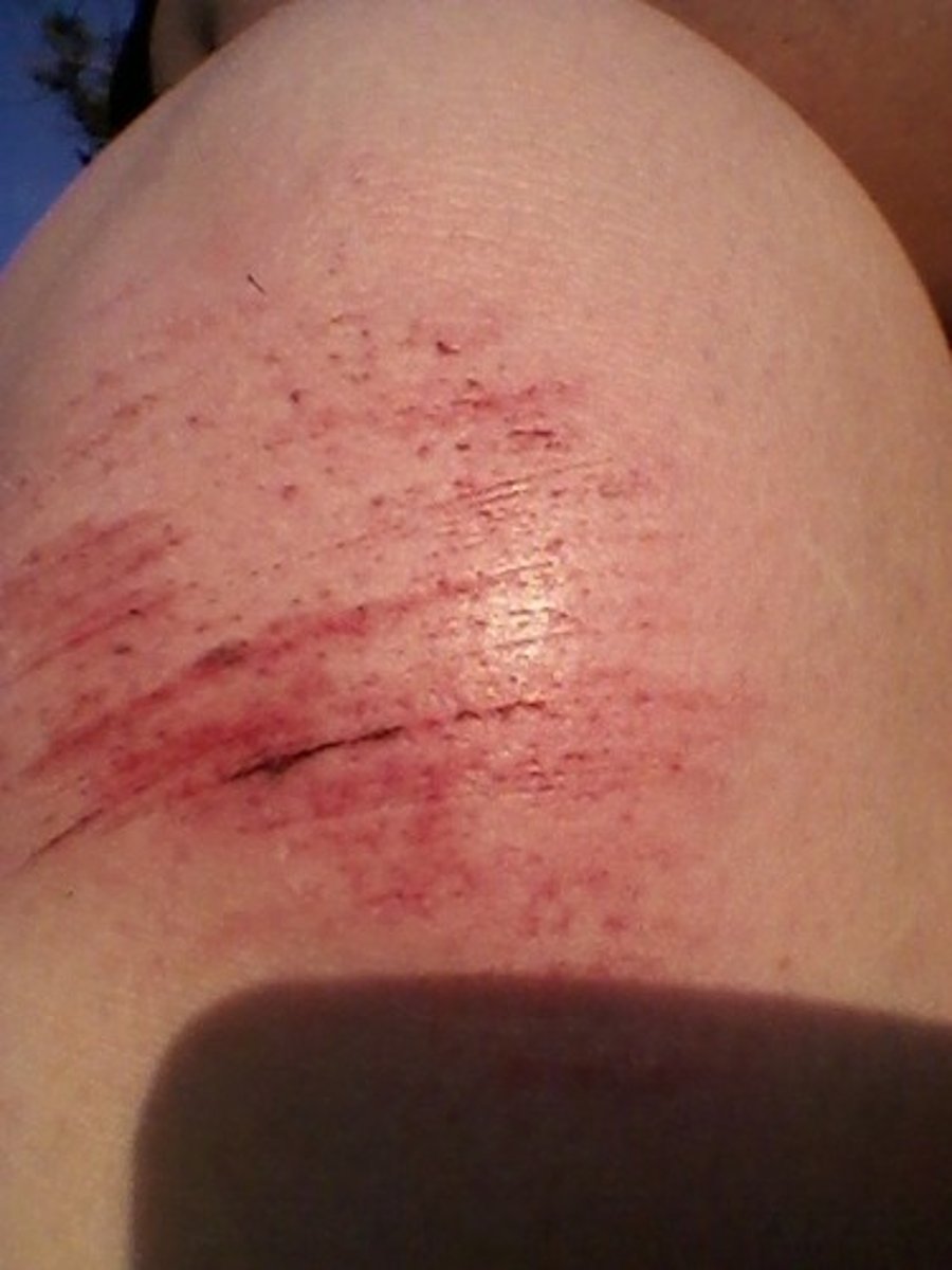 <p>scrapes</p>