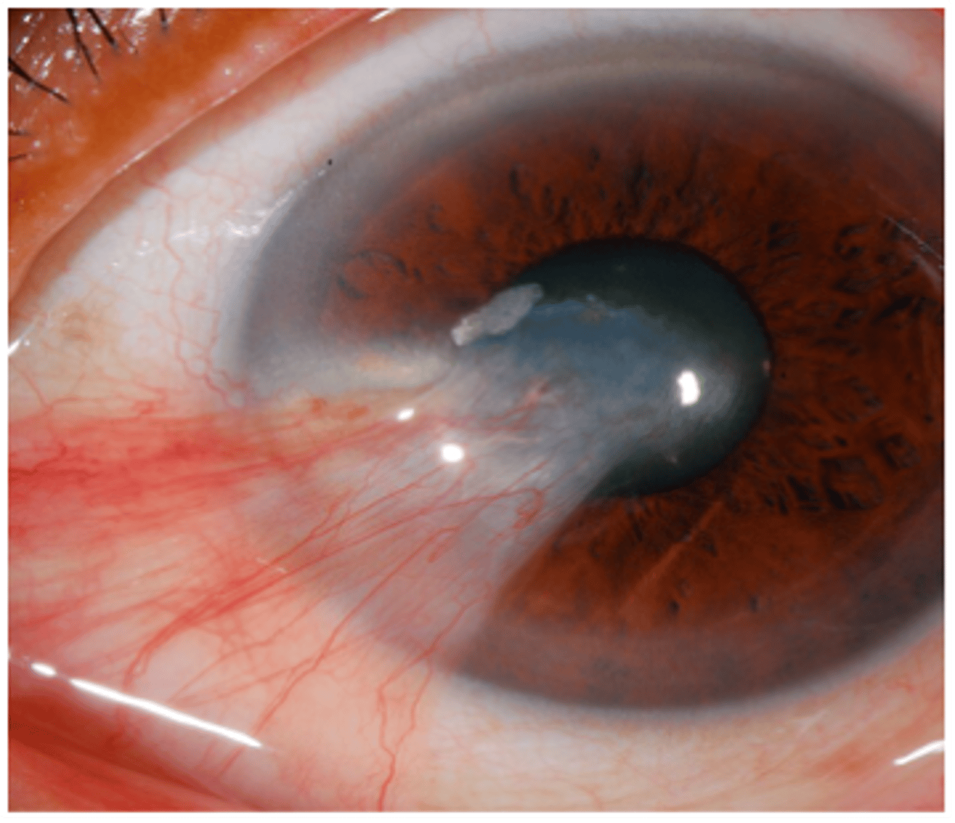 <p>name the conjunctival abnormality</p>