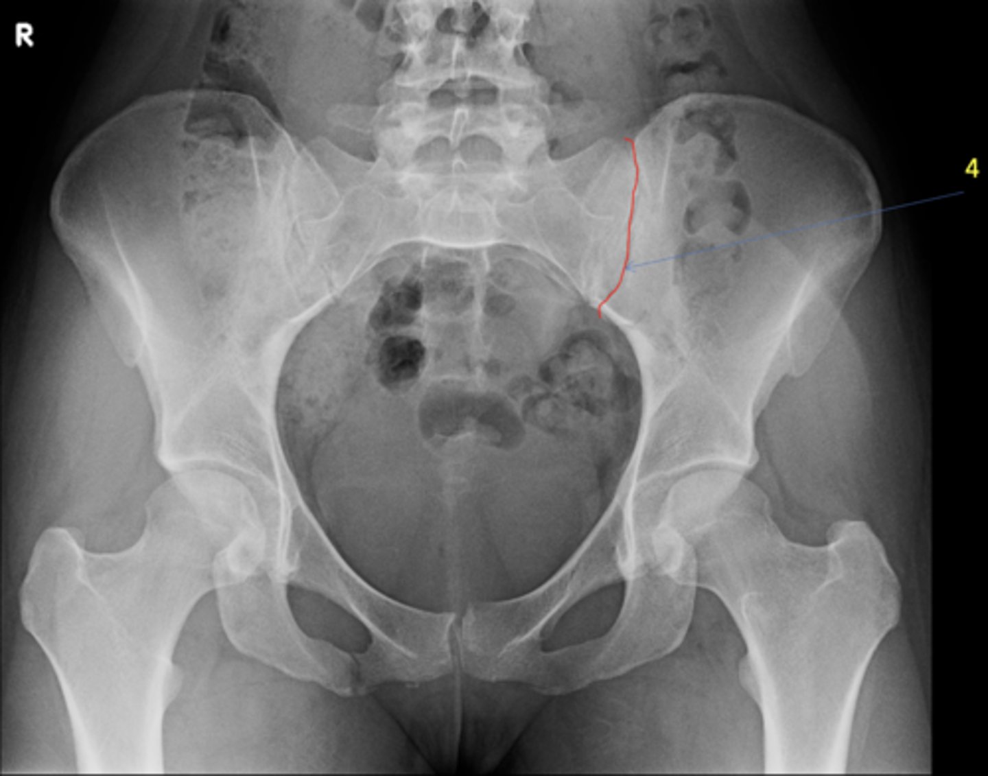 <p>ID 4 (joint)</p>