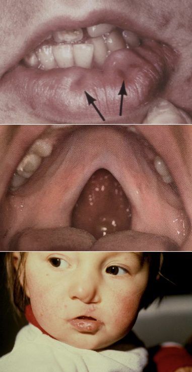 <p><span style="color: rgb(0, 0, 0)">Paramedian lip pits</span></p><ul><li><p><span style="color: rgb(0, 0, 0)">Congenital invaginations of the lower lip</span></p></li><li><p><span style="color: rgb(0, 0, 0)">Usually bilaterally located</span></p></li><li><p><span style="color: rgb(0, 0, 0)">No tx except evaluate for syndrome (or for esthetics)</span></p></li><li><p><span style="color: rgb(0, 0, 0)">Autosomal Dominant</span></p></li><li><p><span style="color: rgb(0, 0, 0)">CL + CP or CP only</span></p></li><li><p><span style="color: rgb(0, 0, 0)">Paramedian lip pits</span></p></li></ul><p></p>