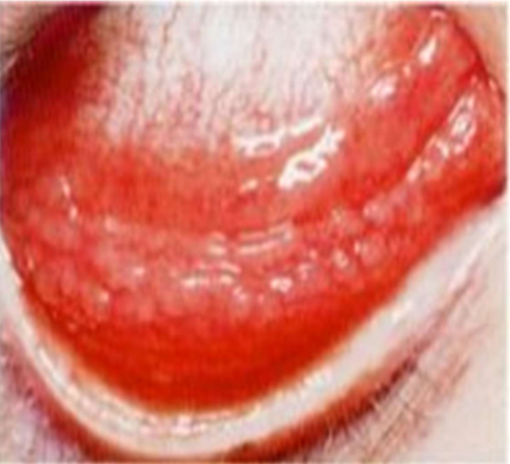 <p>looseness of substantia propria in the forniceal conj permits fluid accumulation (edema) accumulation of mast cells, lymphocytes, etc. in substantia propria</p>