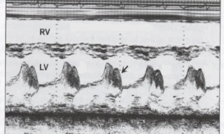 <p><span><span>What cardiac pathology does this m-mode represent?</span></span></p><p>Mitral stenosis</p><p>Left atrial myxoma</p><p>Aortic insuffiency</p><p>Infective endocarditis</p>