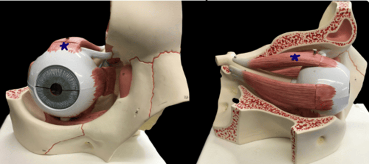 <p>top of the eye muscle</p>