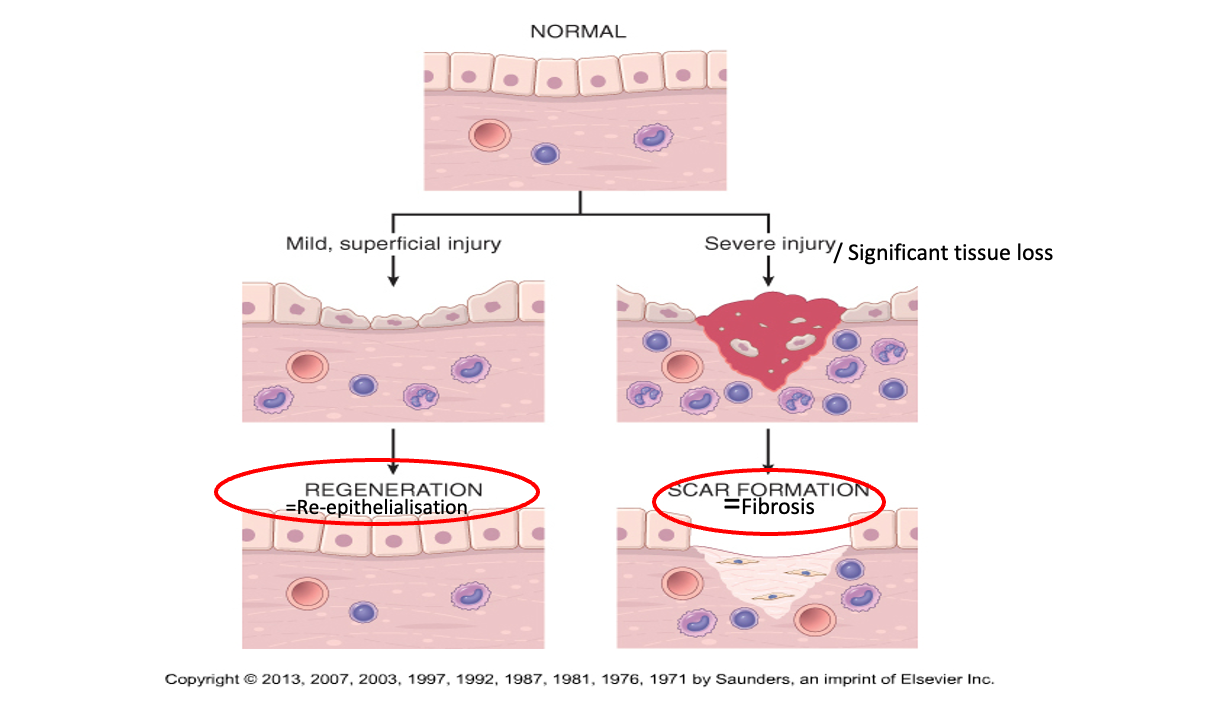 <ul><li><p><span style="font-size: calc(var(--scale-factor)*18.02px)">Stem cells proliferate to replace the damaged cells</span></p></li><li><p>Labile cells, minor injury, clean/sutured cuts</p></li><li><p><span style="font-size: calc(var(--scale-factor)*18.02px)">No/minimal residual damage</span></p></li><li><p><span style="font-size: calc(var(--scale-factor)*15.78px)">e.g. skin, fetal tissue, GIT, endometrium, bone marrow</span></p></li></ul><p></p>