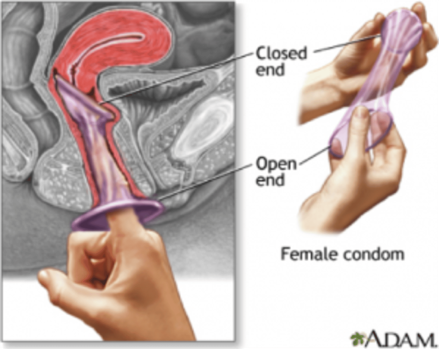 <p>internal and help prevent pregnancy by blocking sperm getting to the egg + packaged with lubricant + available OTC + can be inserted up to 8 hours before intercourse + might help prevent STI's</p>