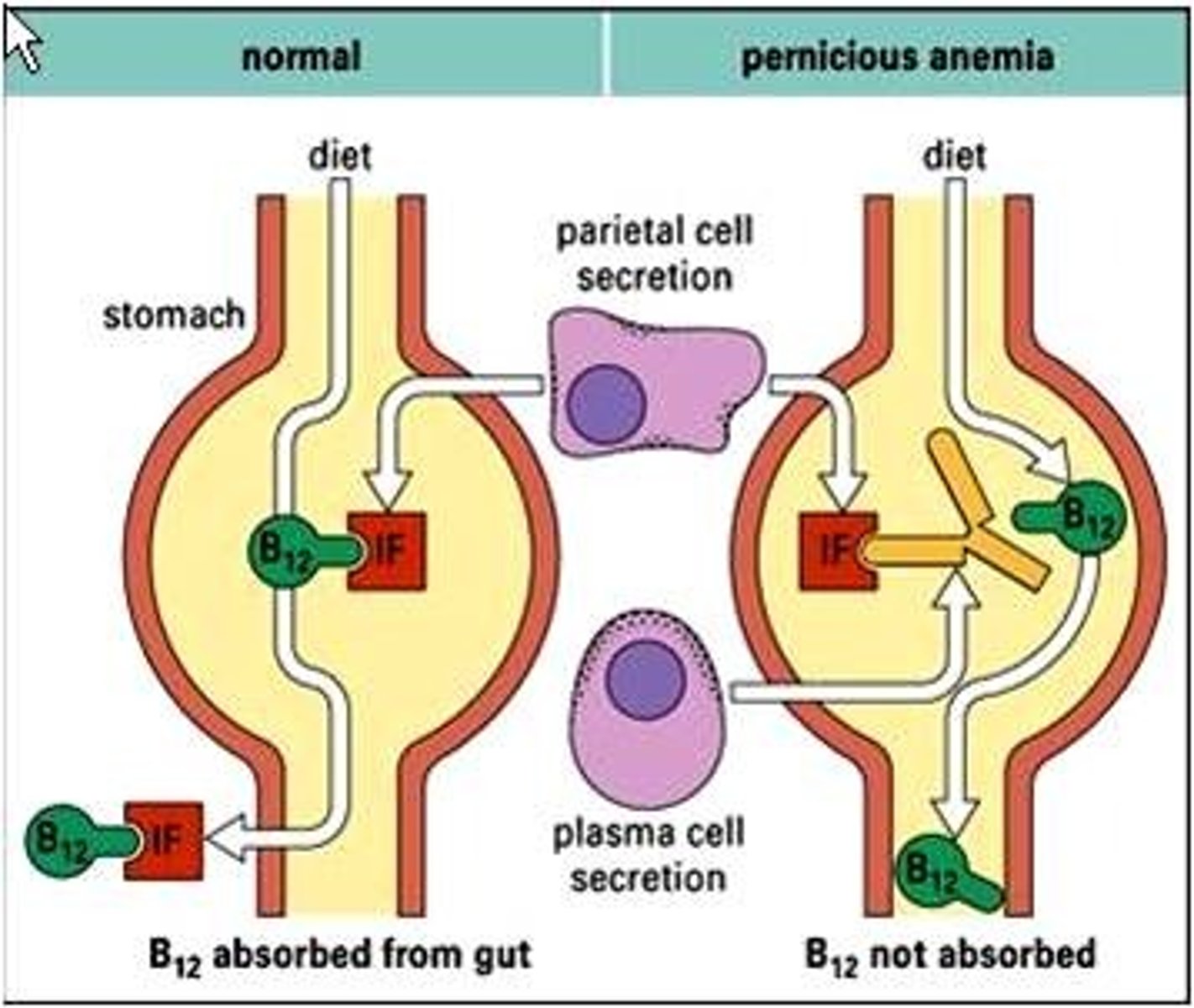 <p>lack of mature erythrocytes caused by inability to absorb vitamin B12 into the bloodstream</p>