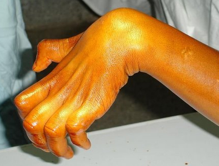 <p>Intrinsic Minus Hand (Claw Hands)</p>