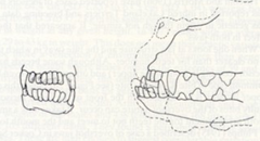 <p>What kind of bite does this brachycephalic dog have?</p>