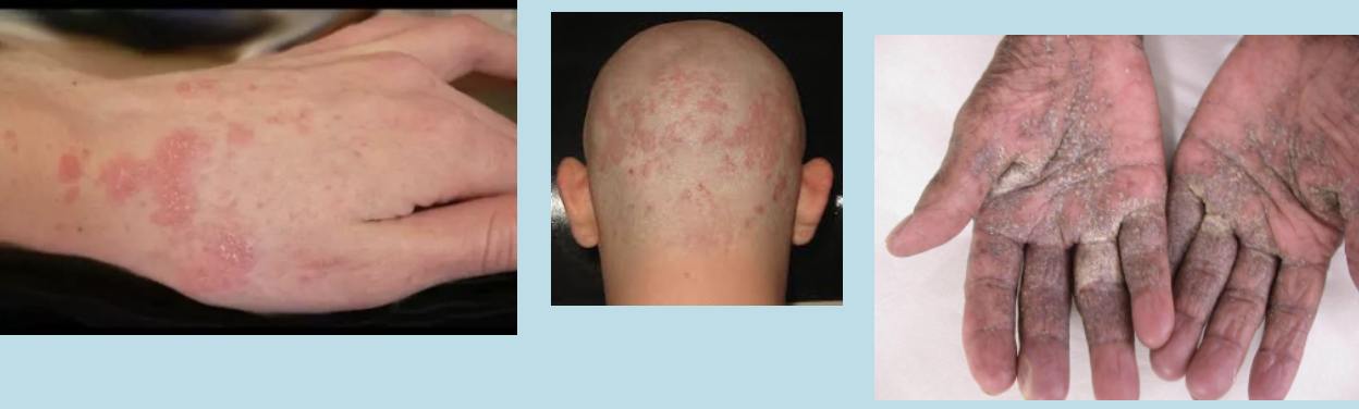 <p>Symptoms and signs of scabies include generalized intense itching; the condition is sometimes called the &quot;seven year itch.&quot;</p><p>Symptoms and signs of scabies on the skin vary and may include short, linear, or nodular &quot;burrows&quot; between the fingers, tiny red bumps and blisters on the skin, or a widespread, crusted rash. Often, there are no visible skin lesions.</p>