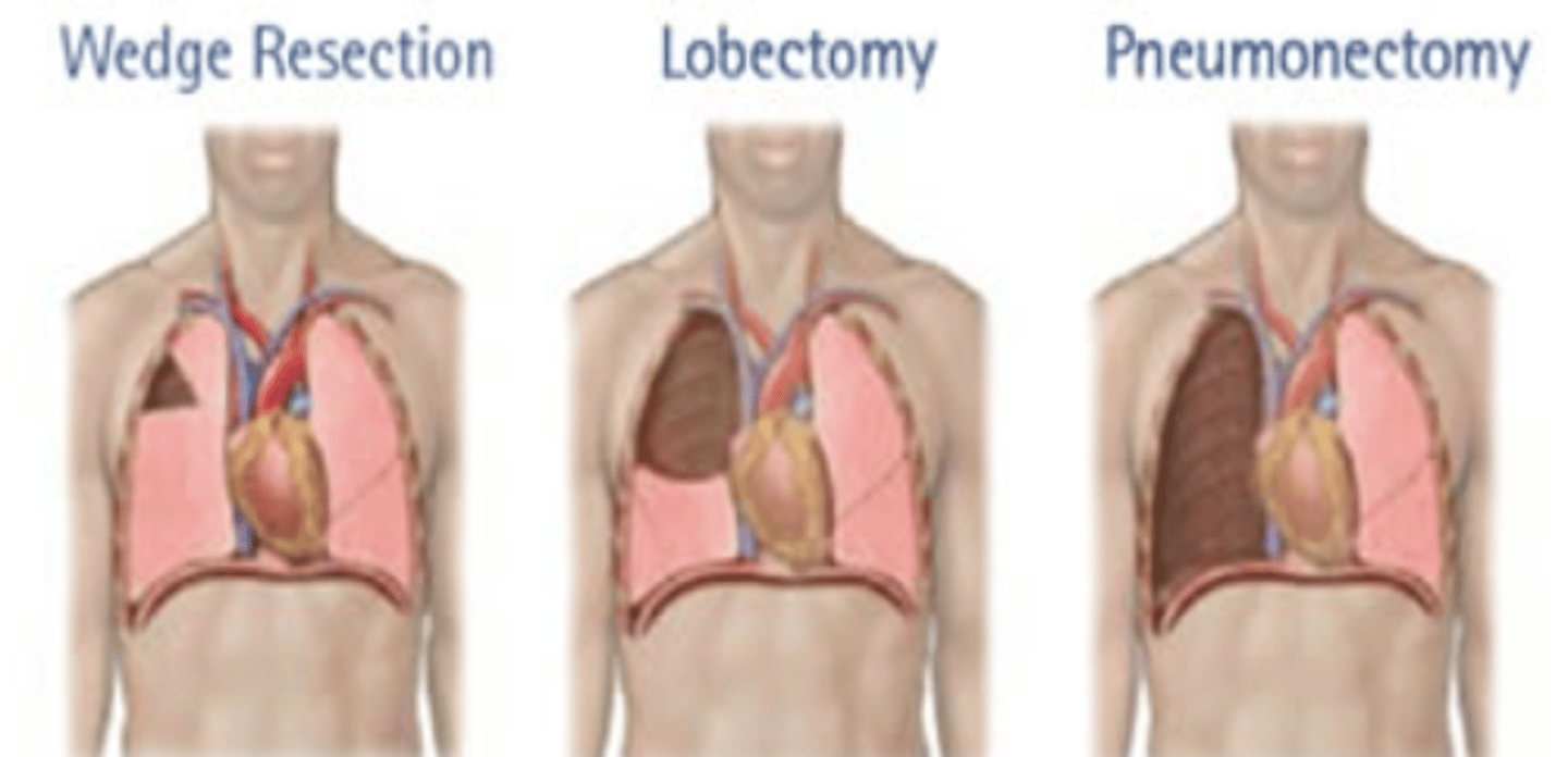 <p><b>lobectomy</b><br>-lobectomy superior to wedge resection may also be done (for patients with limited reserve)</p>