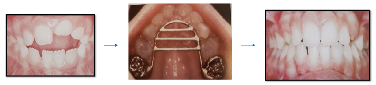 <p>Bitter taste on thumb</p><p>Ace bandage approach</p><p>Insert palatal crib</p>