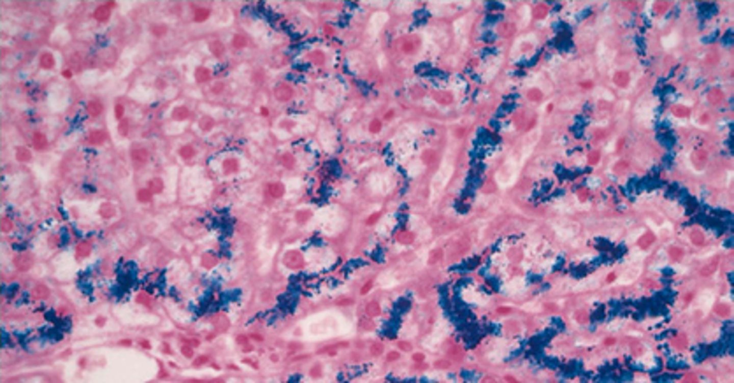 <p>excess iron deposits throughout the liver-> damage and dysfunction</p><p>prussian blue stain</p>