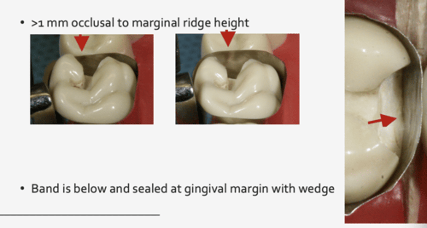 <p>1. easy to apply/ remove</p><p>2. extend below gingival margin</p><p>3. extend above adjacent marginal ridge height</p><p>4. resist deformation during insertion</p>