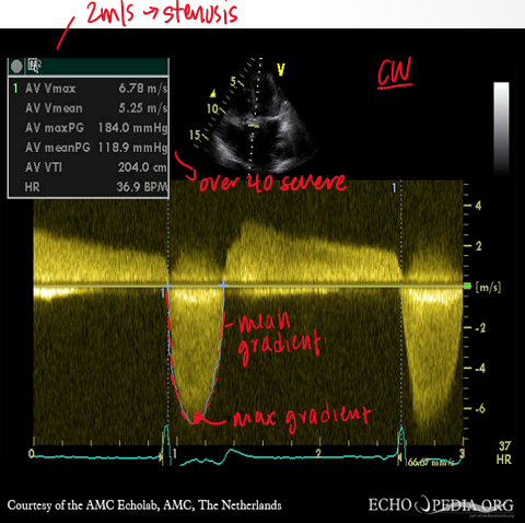 <p>by tracing the velocity curve and avering instantaneous gradients over systolic ejection period</p>