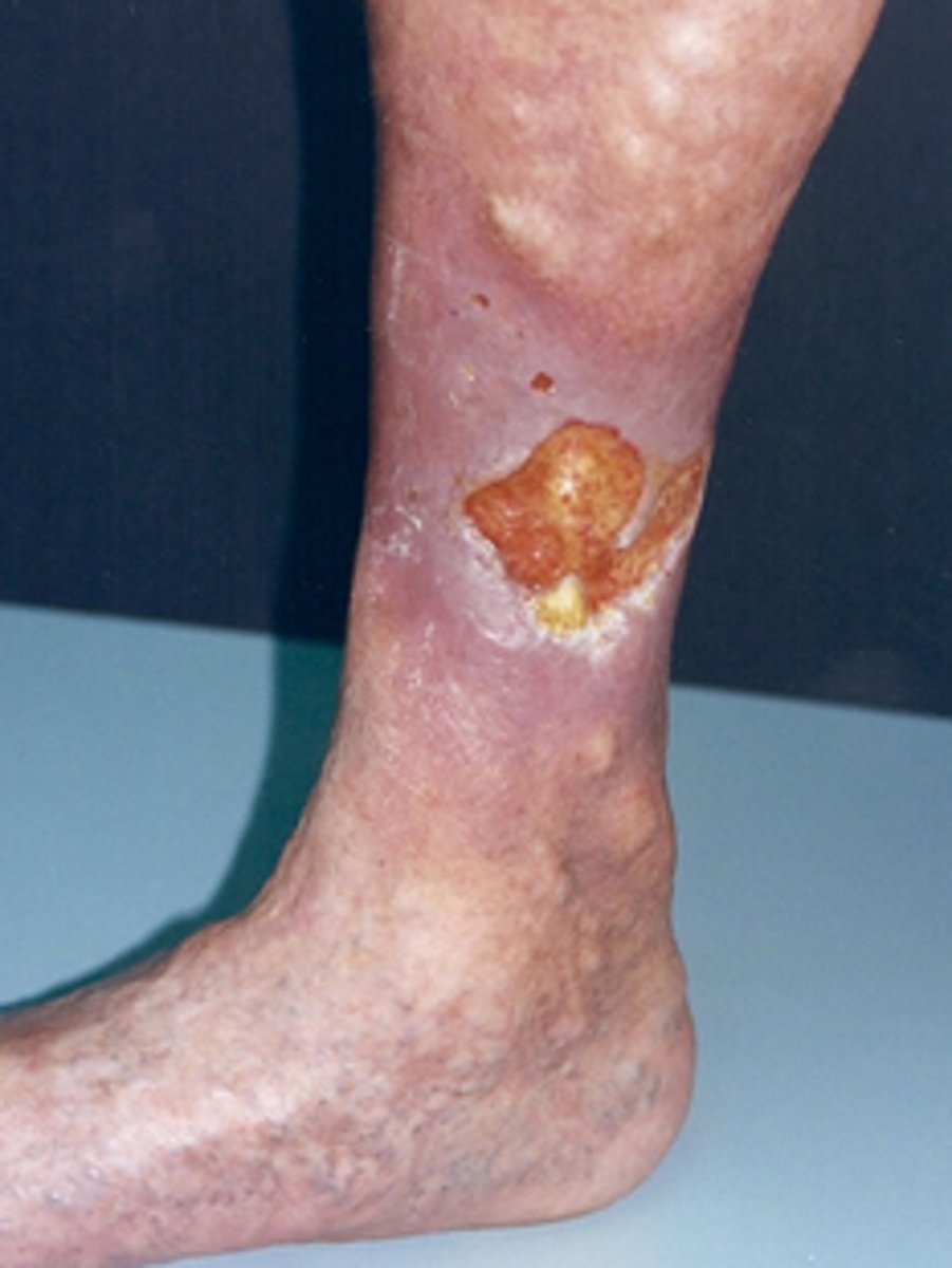 <p>DEBRIDEMENT:</p><p>- selective mechanical and sharp</p><p>DRESSING:</p><p>- "dry" dressing to decrease moisture</p><p>(alginate, hydrocolloid, foam, etc.)</p><p>MODALITIES:</p><p>- pulsed lavage, e-stem, MIST</p><p>PT:</p><p>- control edema w/ compression</p><p>- LE elevation</p><p>- LE strengthening program (calf mm pump)</p>