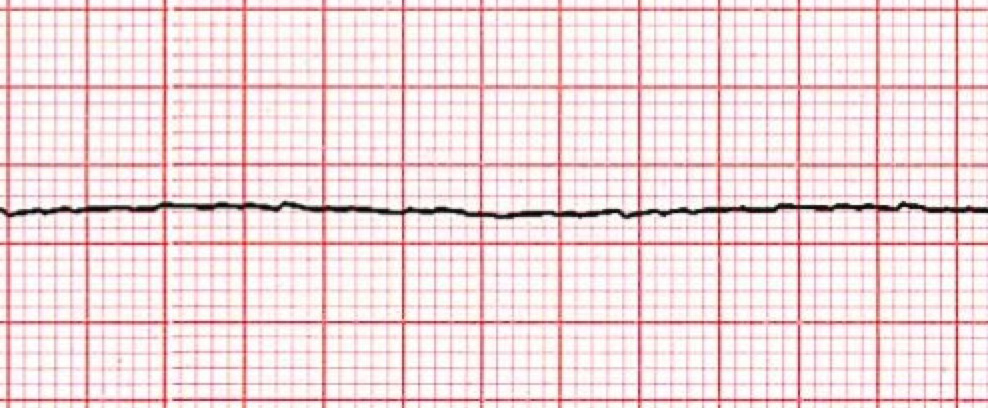 <p>Nonshockable rhythms</p>