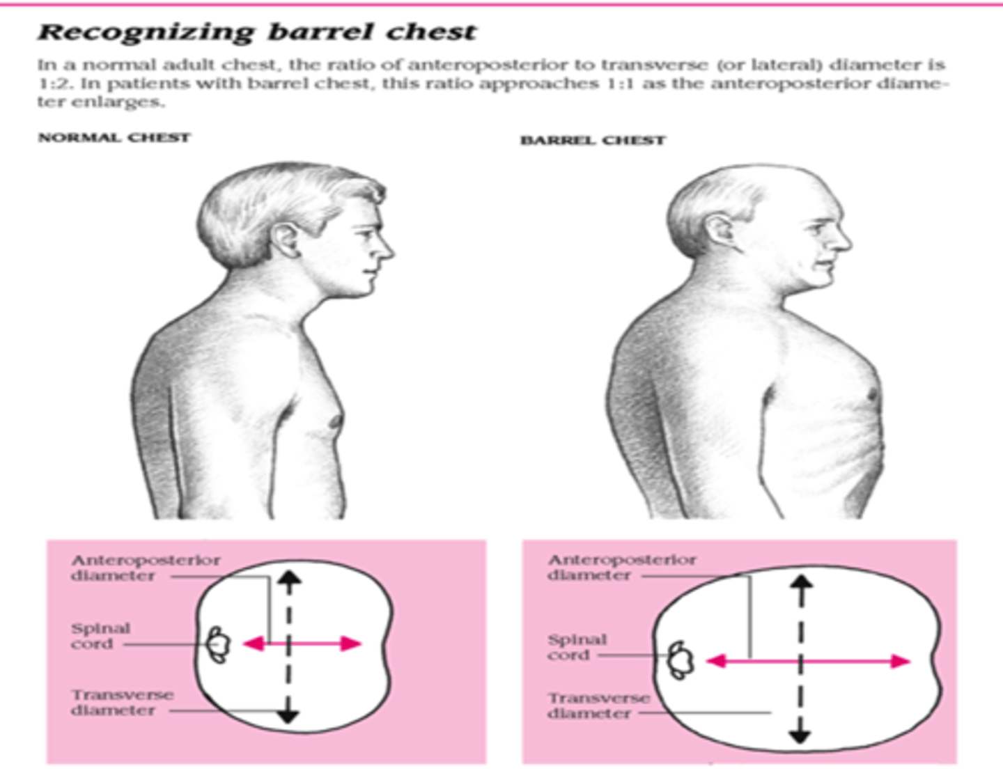 <p>a condition characterized by increased anterior-posterior chest diameter caused by increased functional residual capacity due to air trapping from small airway collapse. A barrel chest is frequently seen in patients with chronic obstructive diseases, such as chronic bronchitis and emphysema.</p>
