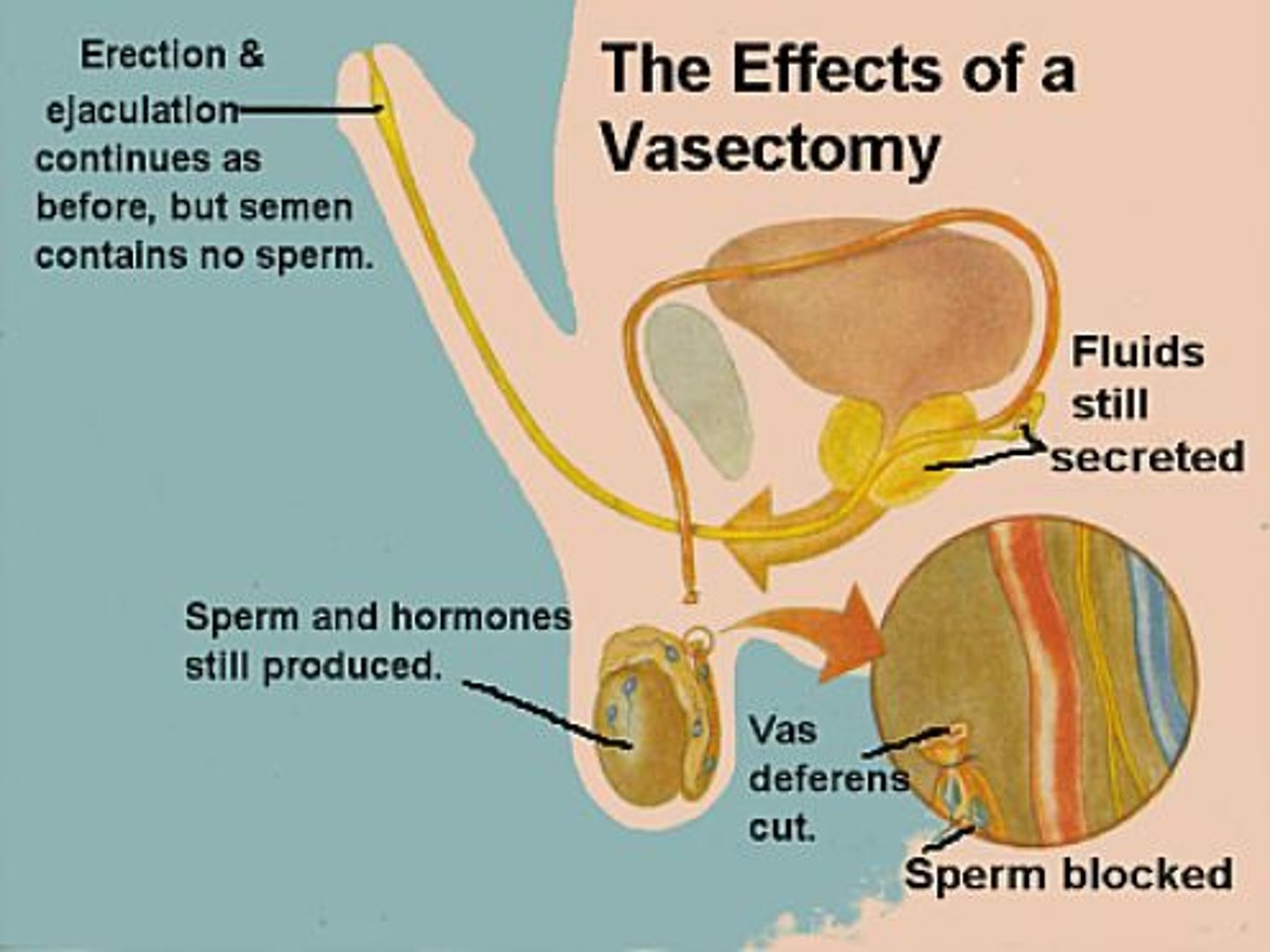 <p>A surgical procedure where the males vas deferens are blocked so that no sperm enter the semen. Monogamous- one relationship, steady. Doesn't protect against stis, and is 99.9% effective in protecting pregnancy.</p>