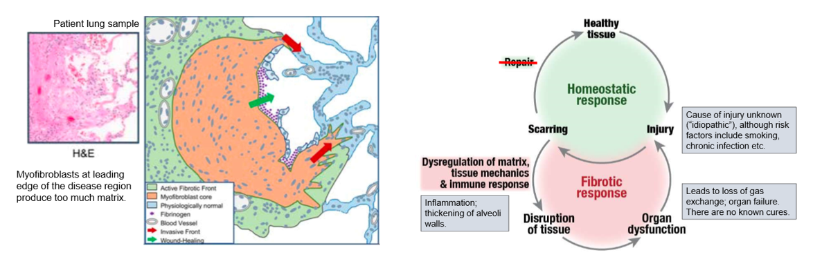 <ul><li><p>build up collagen I causes stiffness and blockage of gas exchange </p></li><li><p>change in tissue mechanics</p></li><li><p>can lead to organ failure</p></li><li><p>positive feedback loop </p></li></ul><p></p>