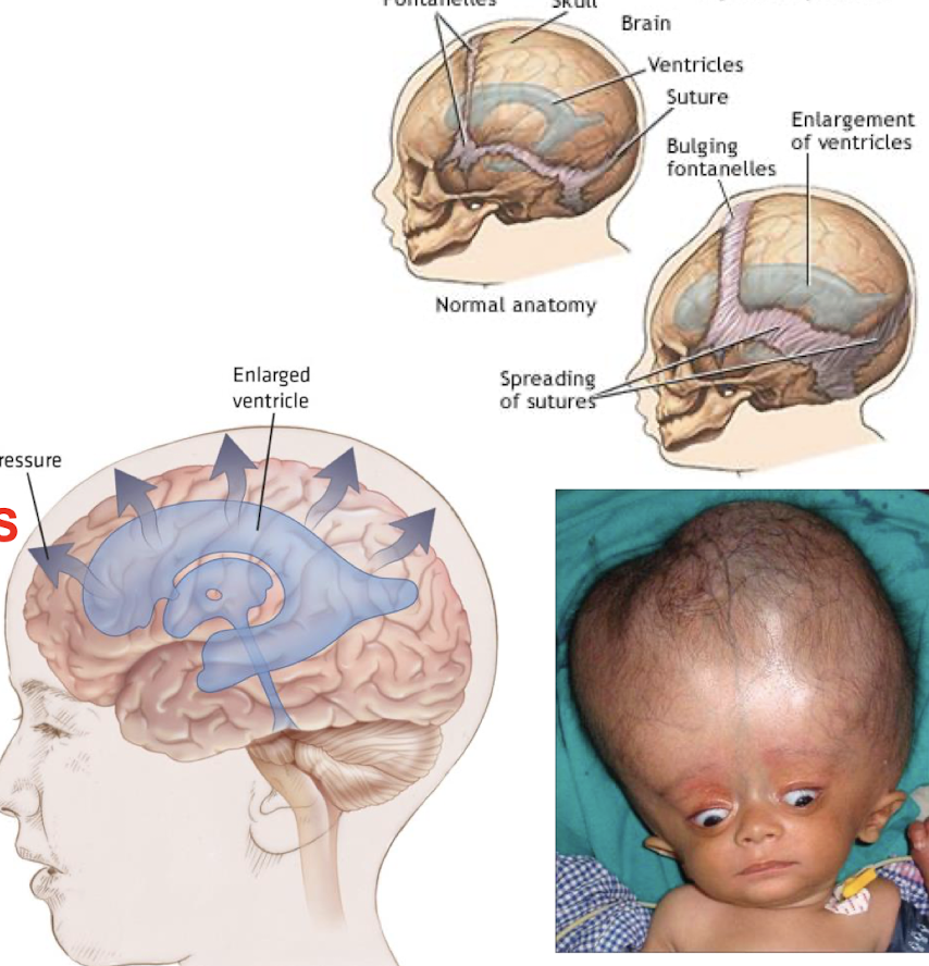 <p>What is hydrocephalus caused by? </p>