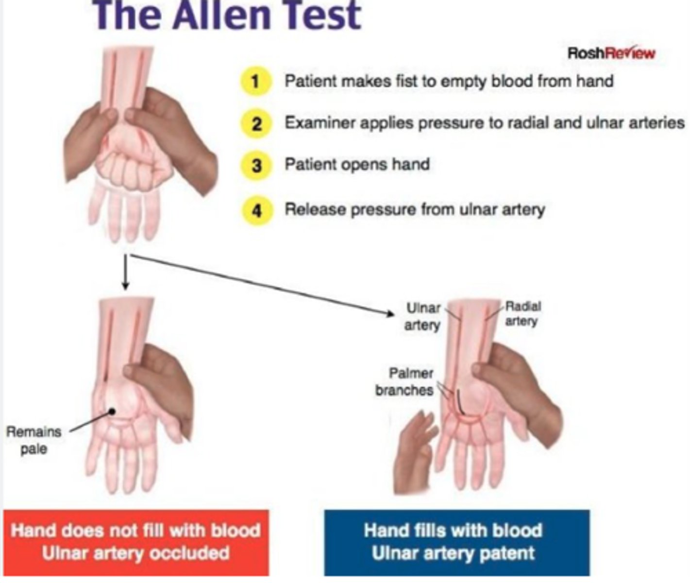 <p><strong><span class="bgB">Allen's Test</span></strong></p><p></p><p></p><p>if the color returns with<strong><span class="bgP">in 5-15 seconds</span></strong>, it indicates that the ulnar artery can sufficiently supply blood to the hand</p>