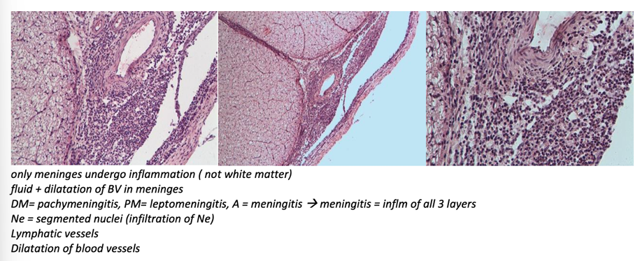 <p><strong>Meningitis spinalis purulenta </strong></p><ul><li><p><em>meninges are dilated and infiltrated by cells</em></p></li></ul><p></p>