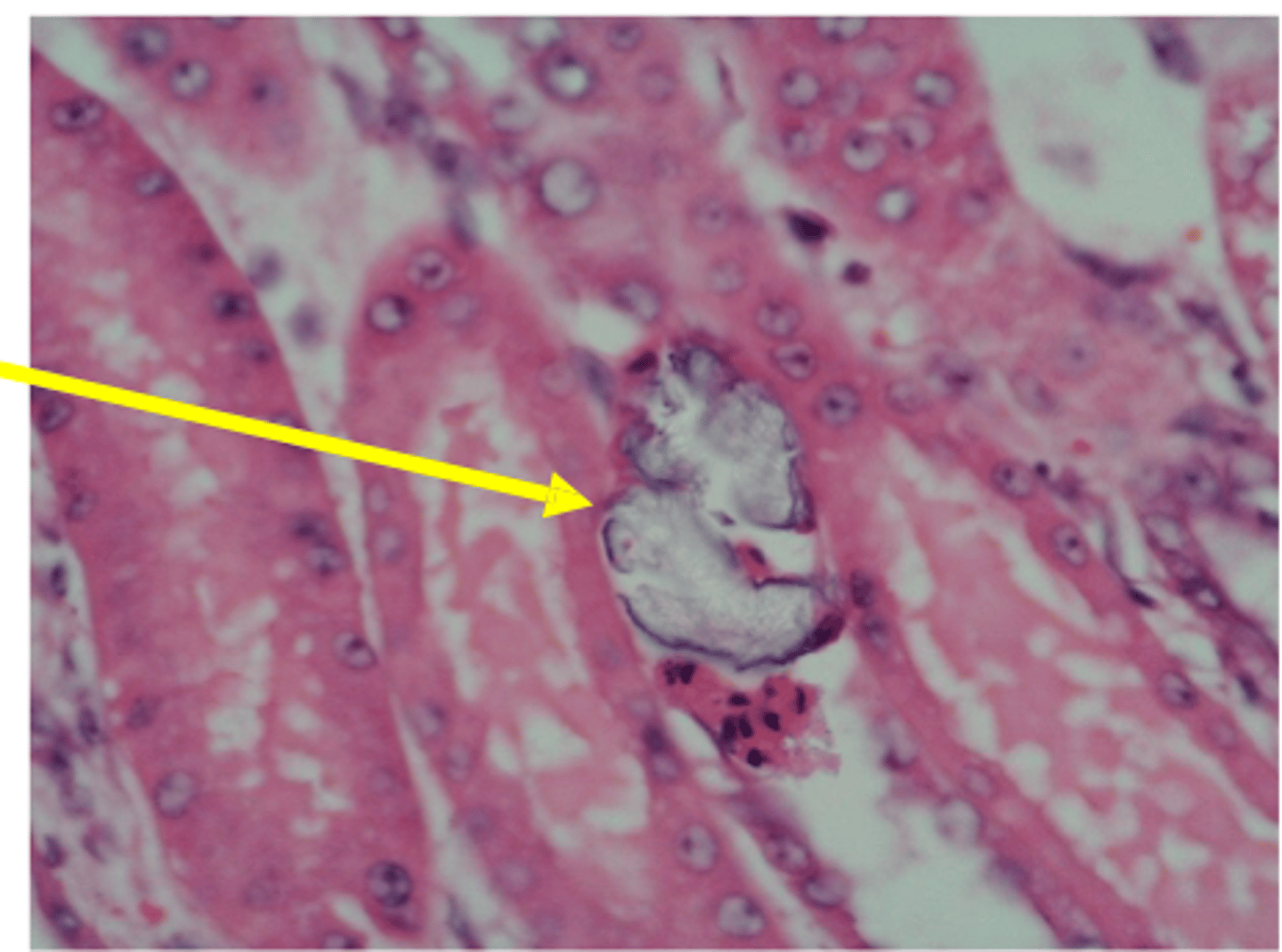<p>Calcium oxalate crystal precipitate in the tubules causing obstruction</p>