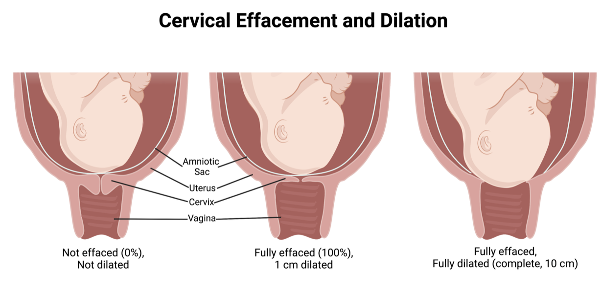 <ul><li><p>given vaginally</p></li><li><p>softens the cervix</p></li><li><p>promotes dilation and effacement </p></li></ul><p></p>