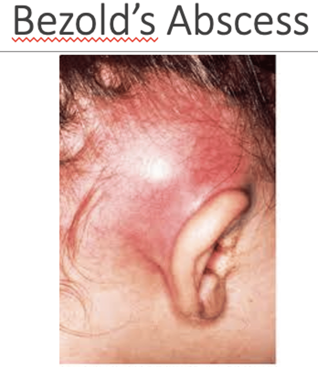 <p>-Complication of Acute Otitis Media</p><p>-Spreads to antrum of mastoid</p><p>-Agents: MC is S. Pneumo</p><p>-Symptoms: Hx of AOM; post-auricular pain; erythema; fever</p><p>-CT findings: Coalescence of mastoid air cells due to bone destruction</p>