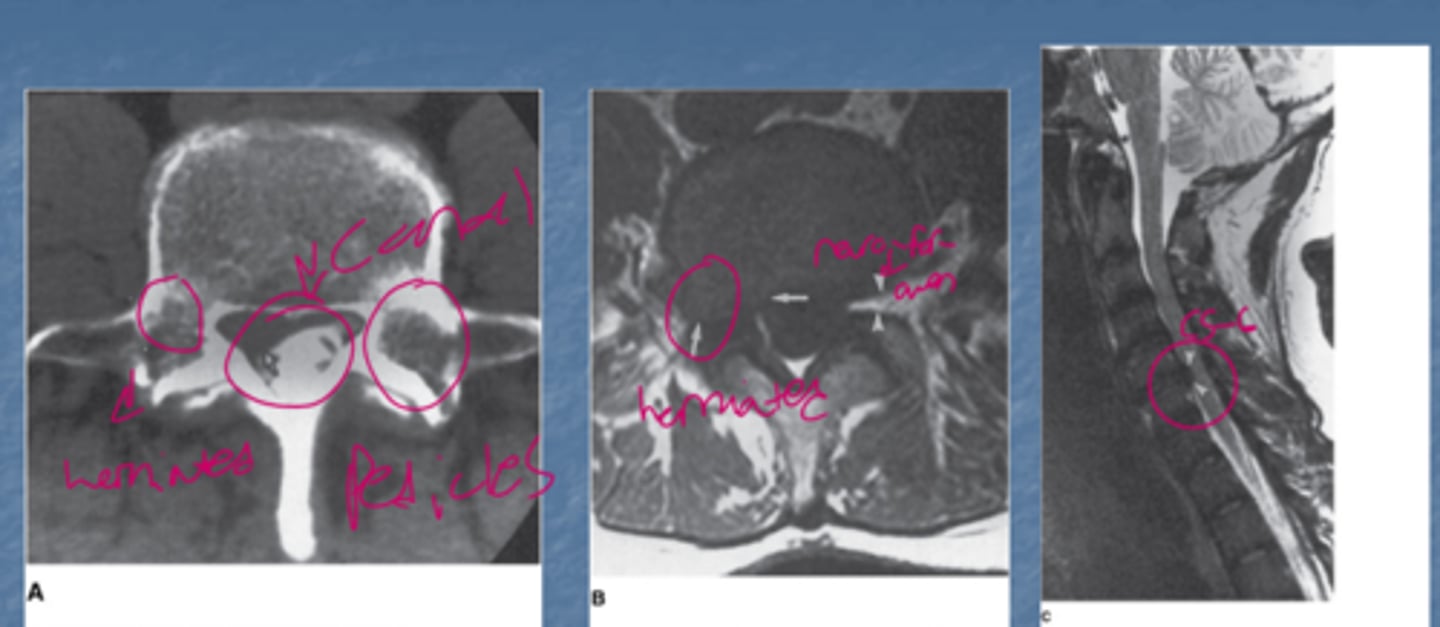 <p>Note that there is compression at the L4-L5 disk space from a herniated disc</p>