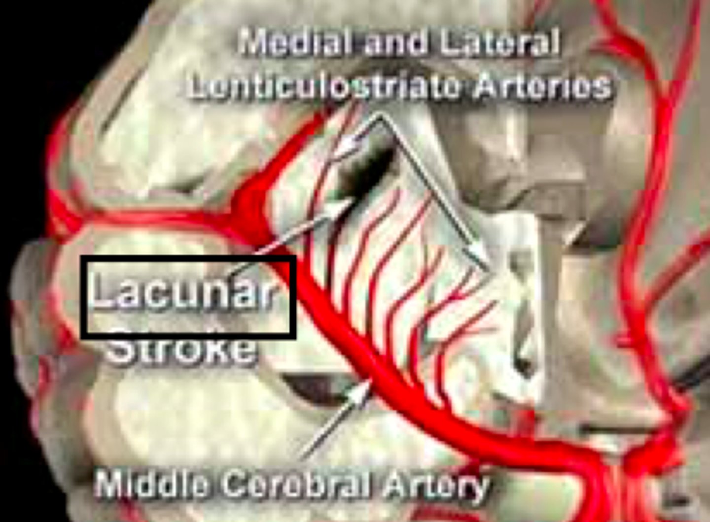 <p>a stroke resulting from occlusion of a small penetrating artery with development of a cavity in the place of the infarcted brain tissue</p><p>- less dysfunction</p><p>- smaller areas</p>