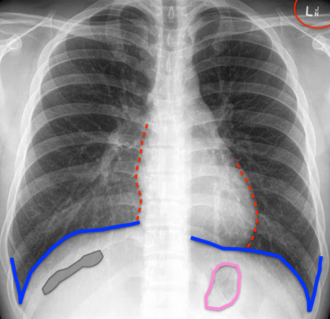 <p>What do the lucencies in the diaphragm represent?</p>
