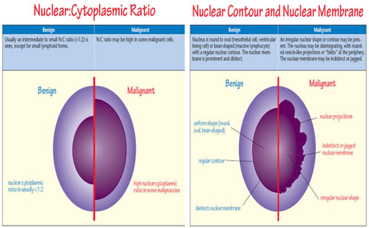 <p>-large to giant</p><p>-HIGH N:C ratio</p><p>-IRREGULAR nuclear borders</p><p>-prominent nucleoli</p><p>-irregularly clumped chromatin</p><p>ADENOCARCINOMA and small cell carcinoma cells are most common</p>