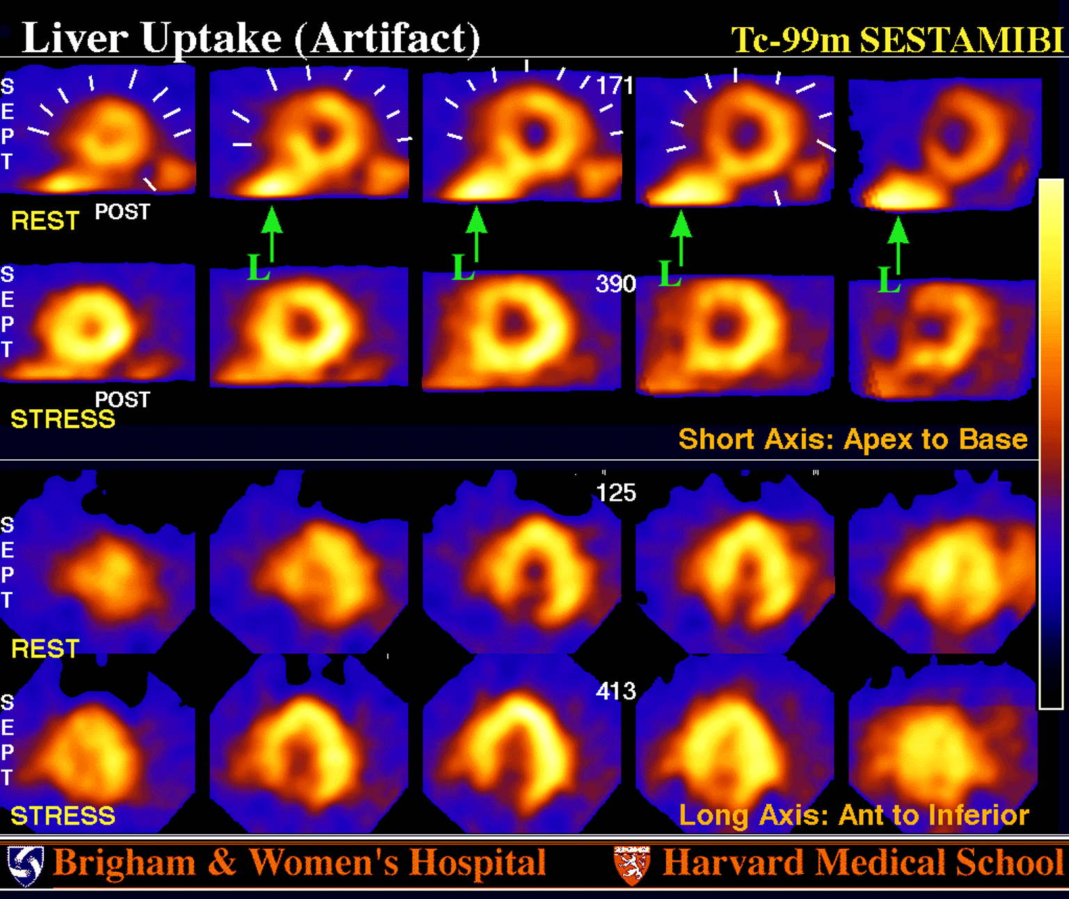 <p>Why is LBBB a less likely cause here?</p>