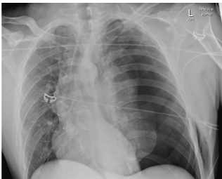 <ul><li><p>ipsilateral diaphragm depressed and flattened </p></li><li><p>mediastinum and heart pushed to other side</p></li></ul><p></p>