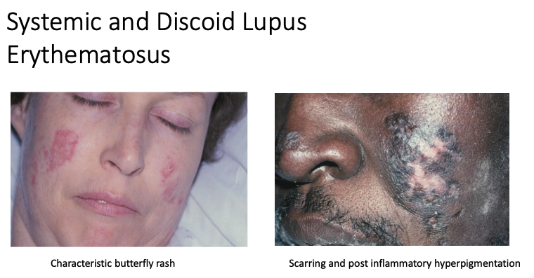 <p>sytemic and discoid</p>