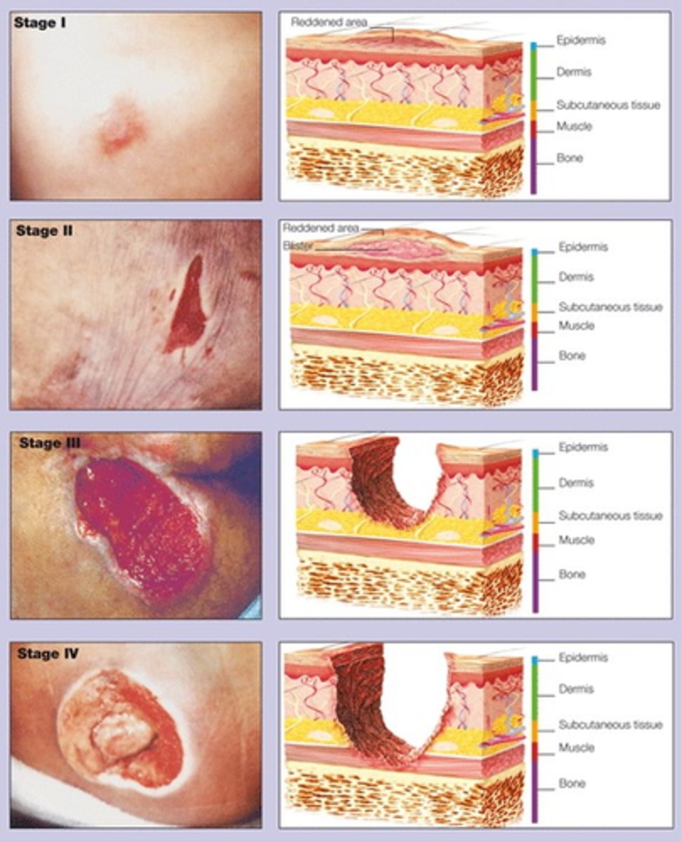 <p>1) superficial</p><p>- damage to epidermis</p><p>- normal upward migration of epidermal cells</p><p>2) superficial partial thickness</p><p>- papillary dermis (1ST LAYER)</p><p>- re-epithelialization</p><p>3) deep partial thickness</p><p>- reticular dermis (2ND LAYER)</p><p>- granulation formation</p><p>4) full thickness</p><p>- subcutaneous </p><p>- granulation formation</p><p>*tendons/ligaments/bone visible</p>