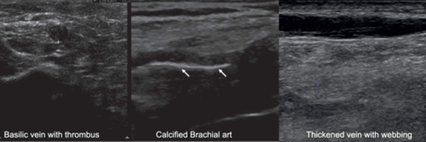 <p>Thrombus</p><p>Calcifications</p><p>Thickened vessels</p><p>Local infection</p><p>Dressings that can't be removed</p><p>Open wounds</p>