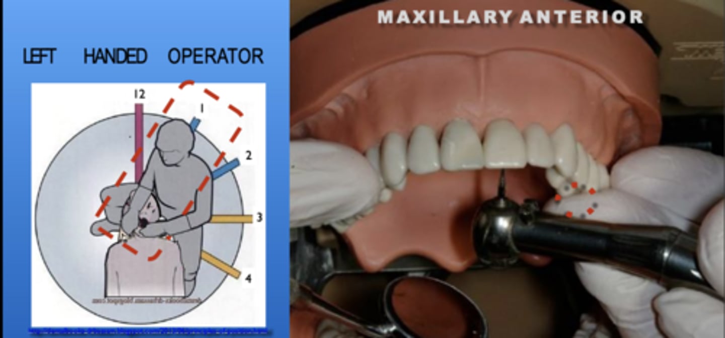 <p>Zone: 1</p><p>Vision: indirect</p><p>Patient's Head: Center</p><p>Fulcrum: Max left premolars (O)</p>